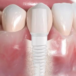 Was macht Keramikimplantate immer beliebter?